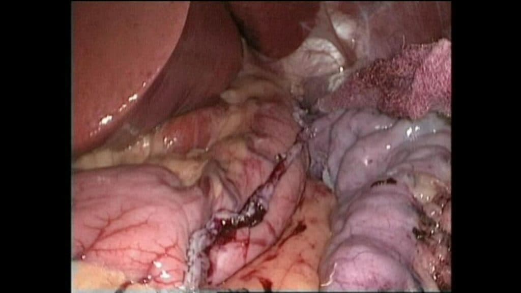 SleeveGastrectomyImg